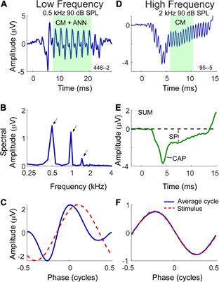 Lack of neural contributions to the summating potential in humans with Meniere’s disease